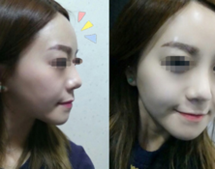 이마필러 완전 맘에 들어요!!