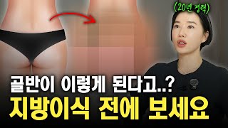 지방이식vs바디필러, 장단점? 부작용? 이 영상으로 종결!