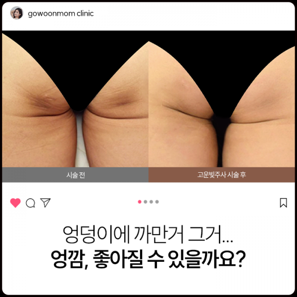 엉덩이에 까만거 그거.. 엉깜, 좋아질 수 있을까요?