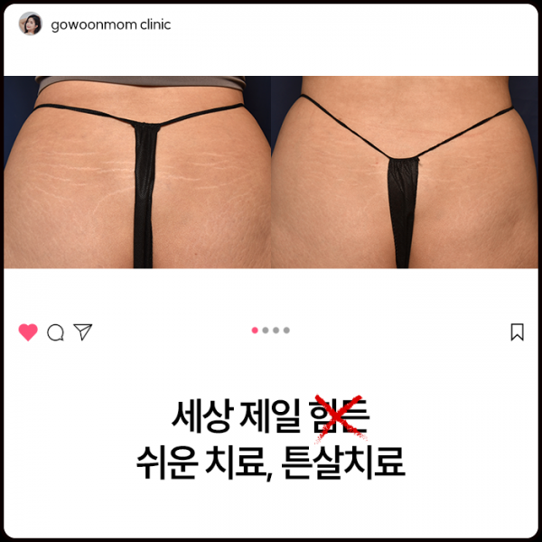 세상 제일 힘든(X) 쉬운(O) 치료, 튼살 치료!