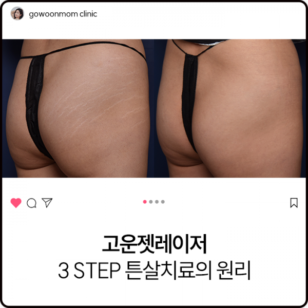고운젯레이저 - 3 step 튼살치료의 원리